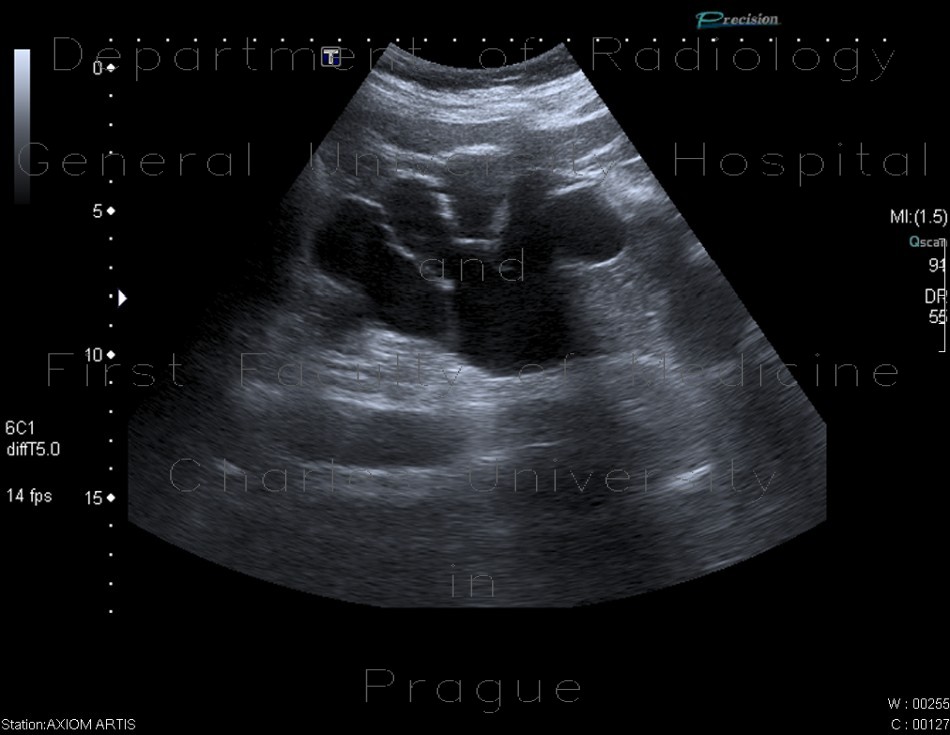 Hydronephrosis, end-stage