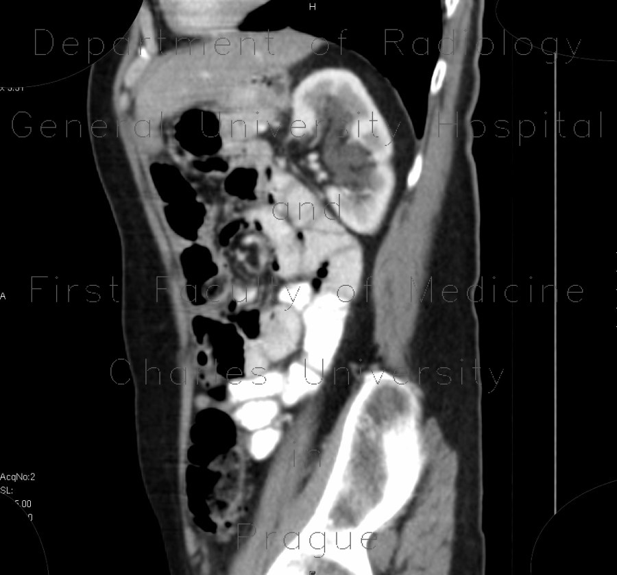 Radiology image - Hydronephrosis, grade II, bilateral, follow-up: Abdomen, Kidney and adrenals, Urinary tract: CT - Computed tomography