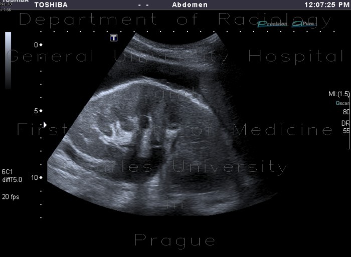 Radiology image - Hydronephrosis, mild edema of kidney: Abdomen, Kidney and adrenals, Urinary tract: US - Ultrasound
