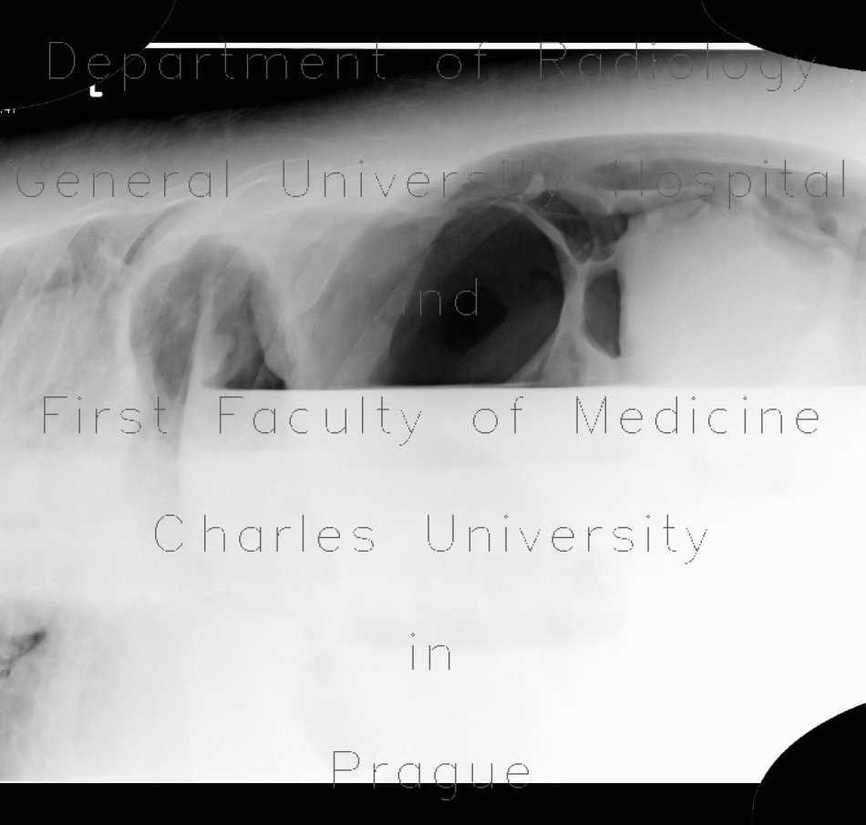 Hydropneumoperitoneum, pneumoperitoneum, ascites, Rigler's sign