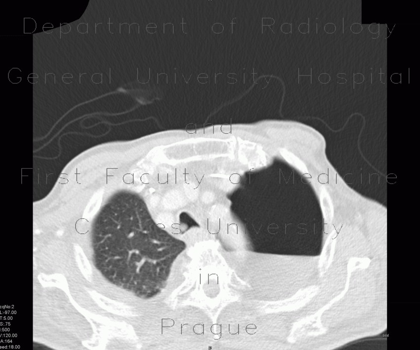 Radiology image - Hydropneumothorax: Thorax, Lung, Mediastinum and pleural cavity: CT - Computed tomography
