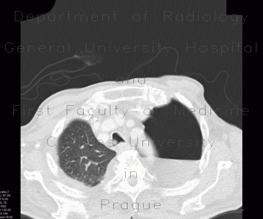 Hydropneumothorax