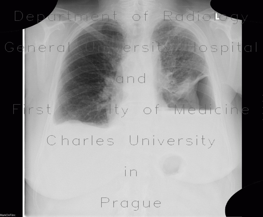 Hydropneumothorax