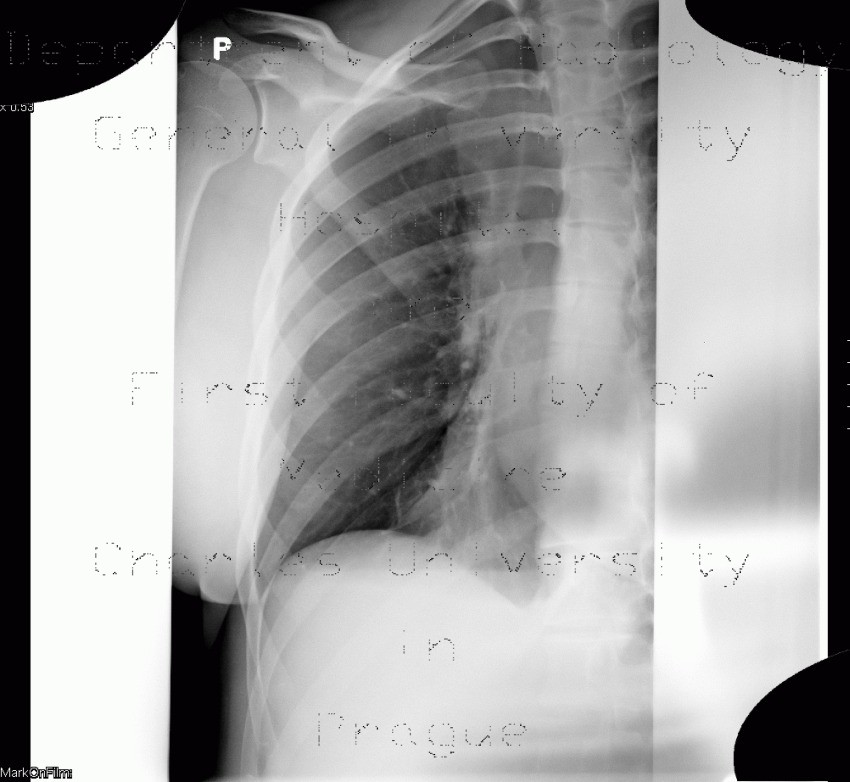 Radiology image - Hydropneumothorax, artifact: Thorax, Lung, Mediastinum and pleural cavity: X-ray - Plain radiograph