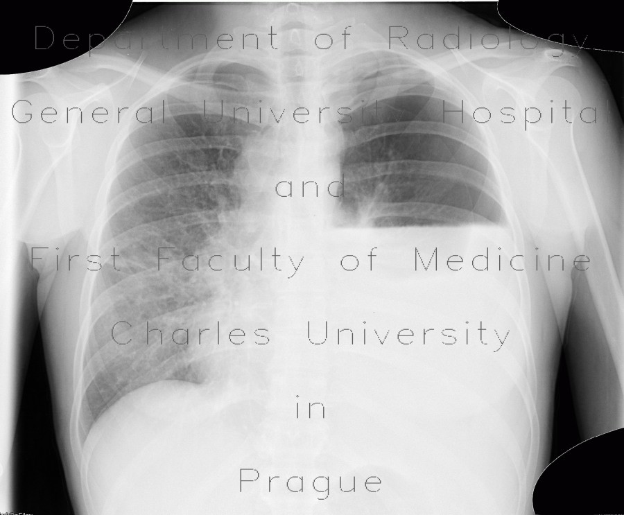 Hydropneumothorax, pneumothorax