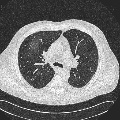Radiology image - Hypersensitivity angiitis, intraalveolar hemorrhage, HRCT: Thorax, Lung: CT - Computed tomography