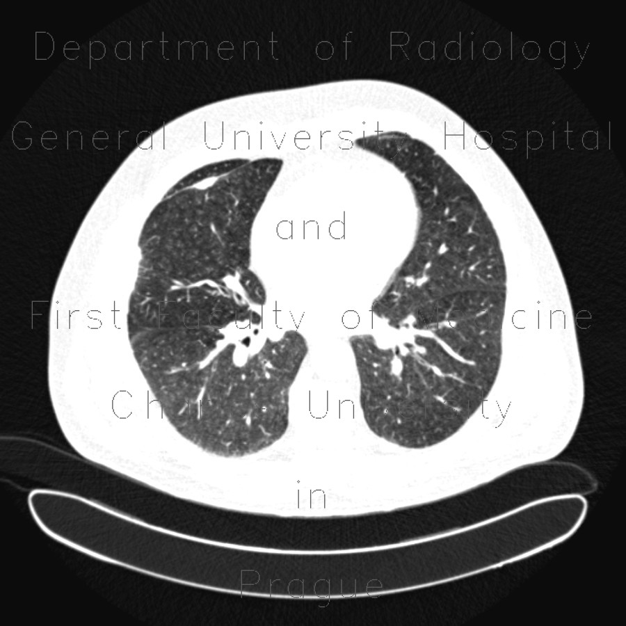 Hypersensitivity pneumonitis, subacute