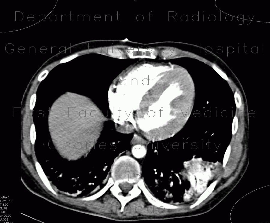 Hypertrophic cardiomyopathy