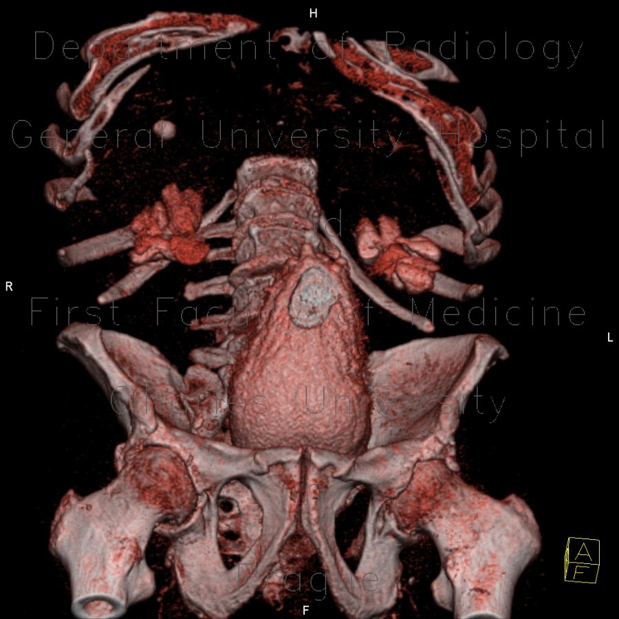 Hypertrophy of bladder wall, urinary bladder, hydronephrosis, CT cystography