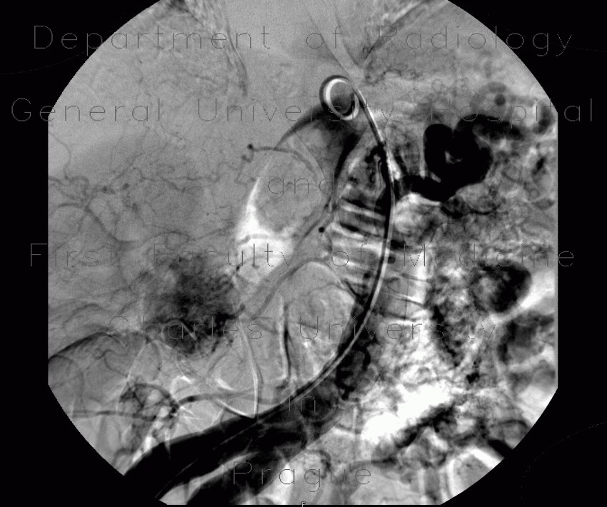 Radiology image - Hypervascular tumour of pancreatic head: Abdomen, Spine and Axial, Bone, Pancreas: AG - Angiography