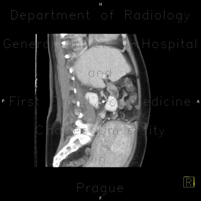 Hypoplasia of inferior vena cava, shunting by hemiazygous vein and vertebral veins