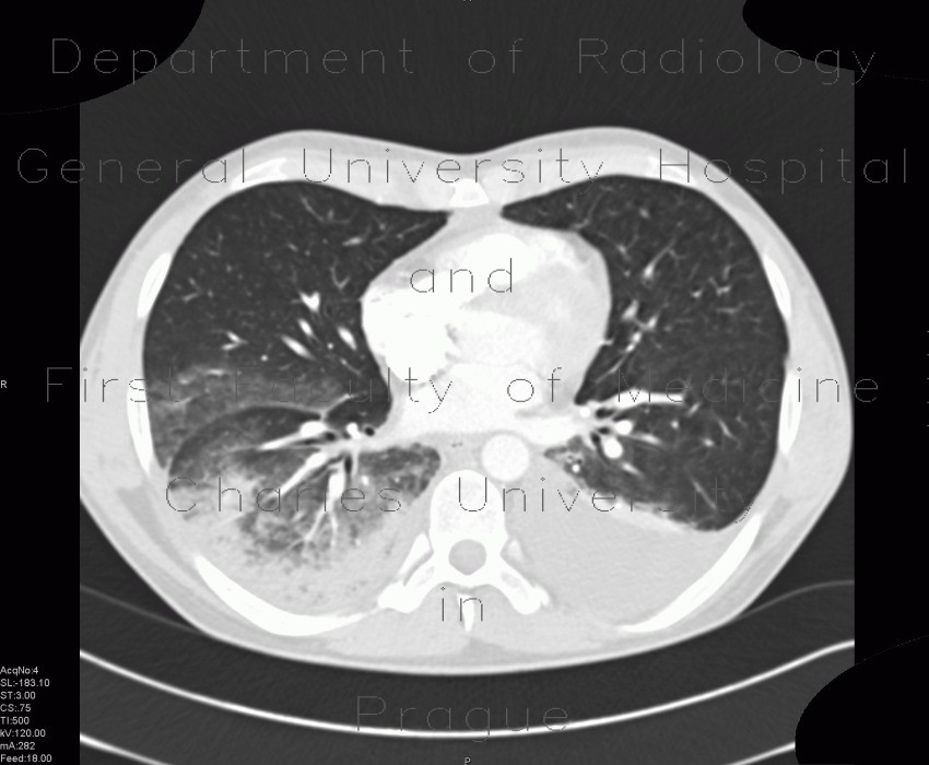 Hypostatic pneumonia, pleural effusion