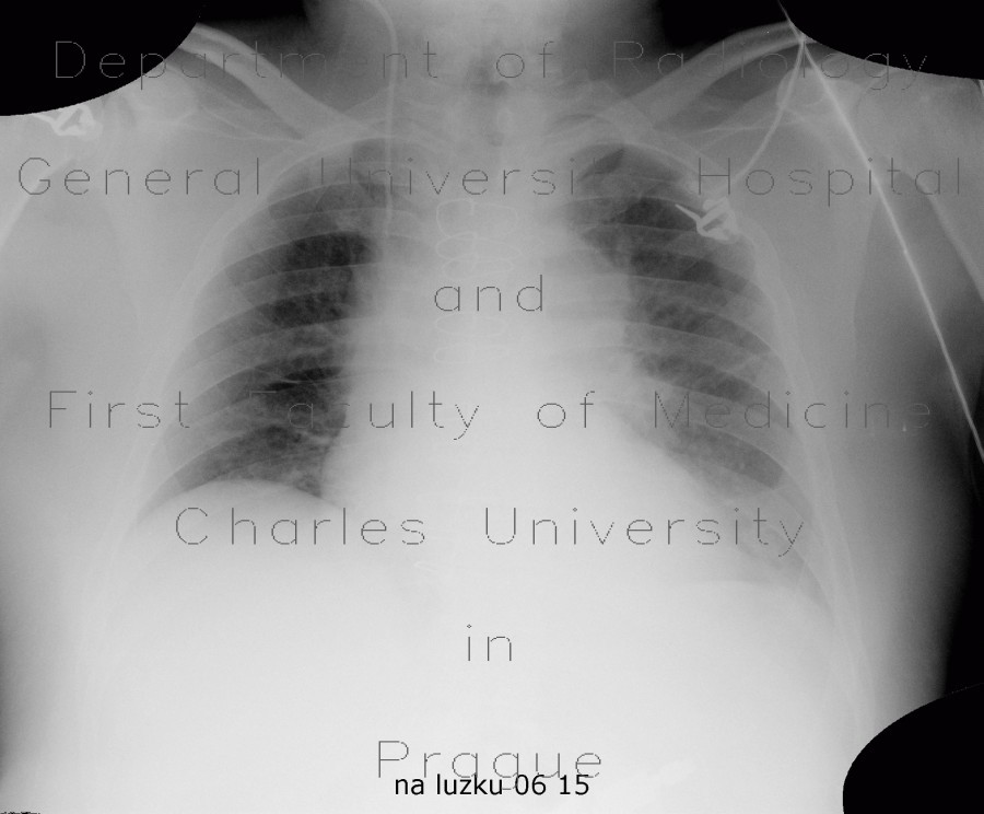 Hypoventilation, atelectasis of lower lung lobe