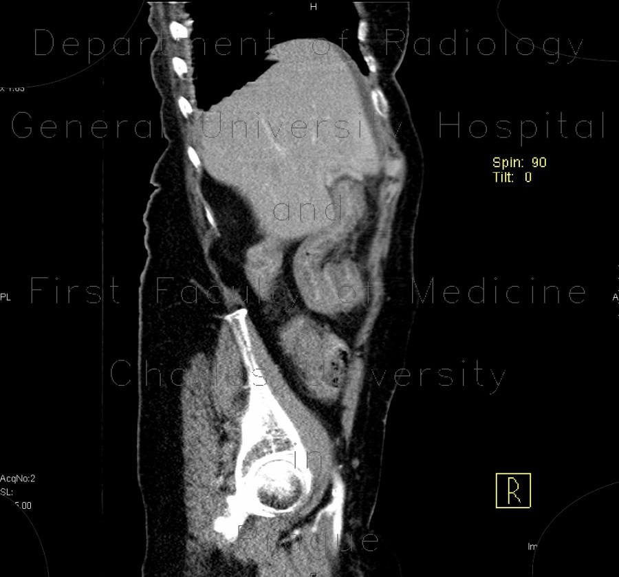 IPMN, intrapapillary mucinous neoplasm, central type, colitis