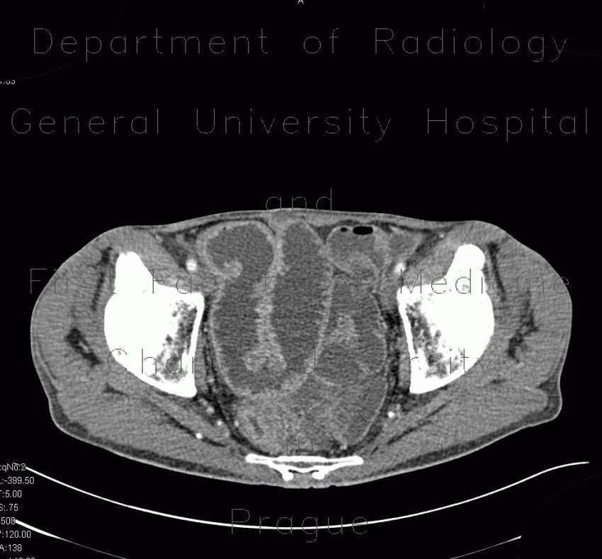 Ileocecal resection, Crohn's disease, CT enterography