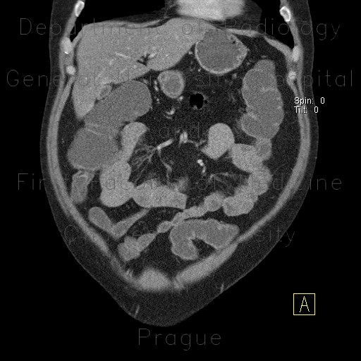 Ileocecal resection, postinflammatory changes of neoterminal ileum, CT enterography