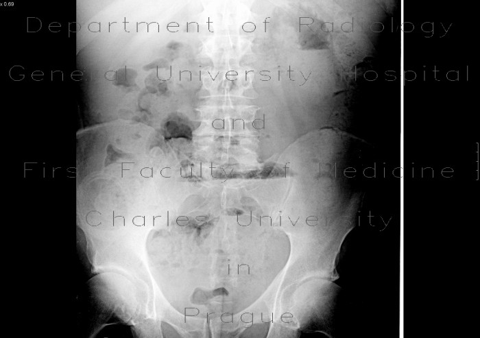 Ileus