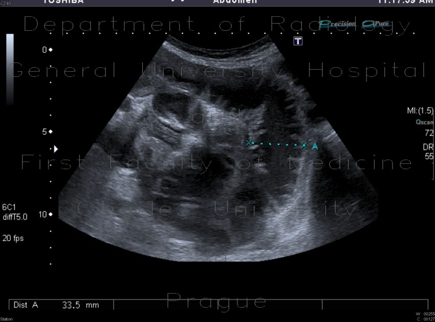 Ileus