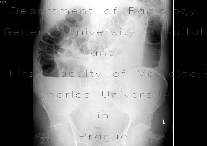 Radiology image - Ileus, large bowel: Abdomen, Large bowel: X-ray - Plain radiograph