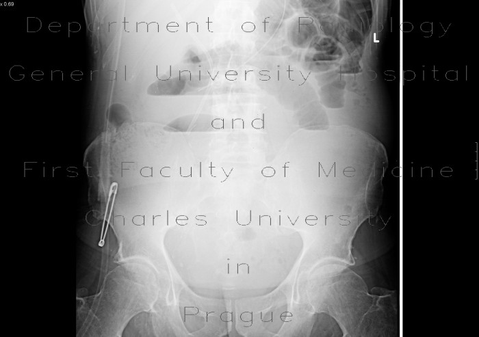 Ileus, small bowel