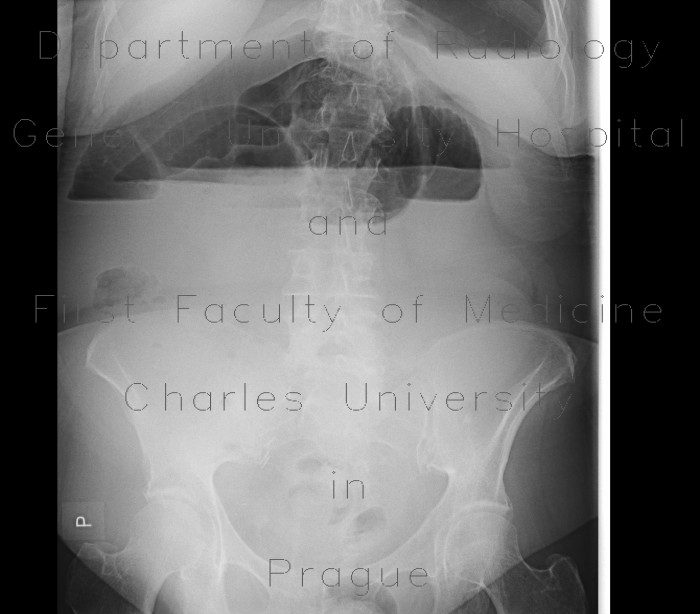 Radiology image - Ileus, small bowel: Abdomen, Small bowel: X-ray - Plain radiograph