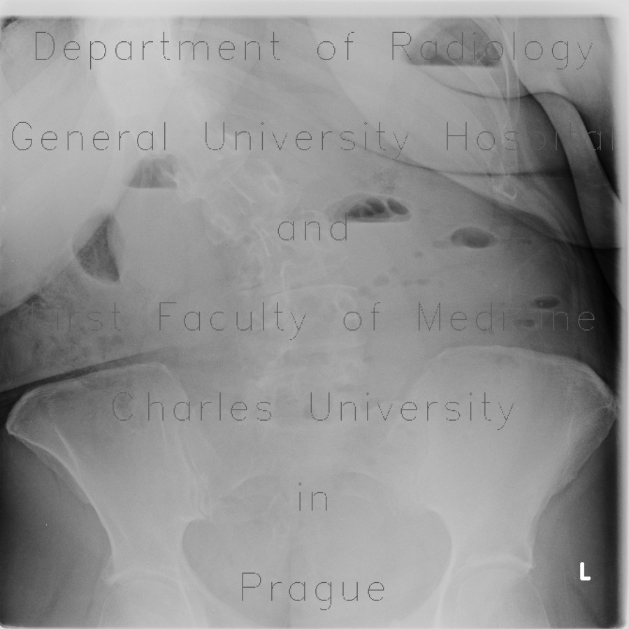 Ileus, small bowel, adhesions