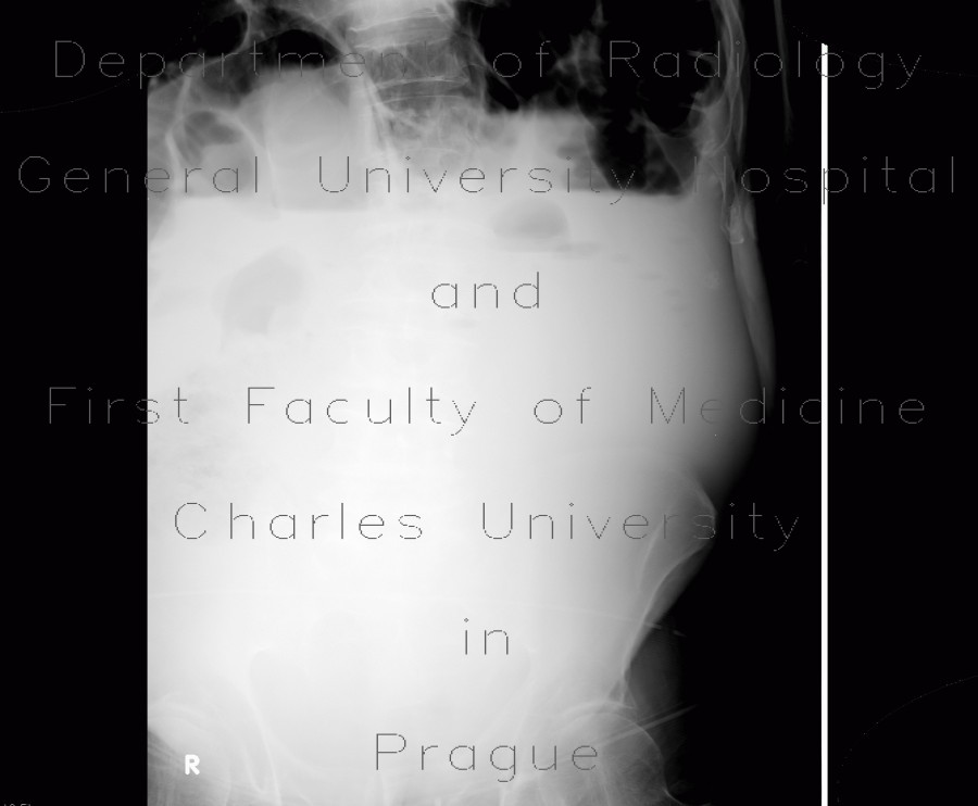 Ileus, small bowel obstruction, SBO