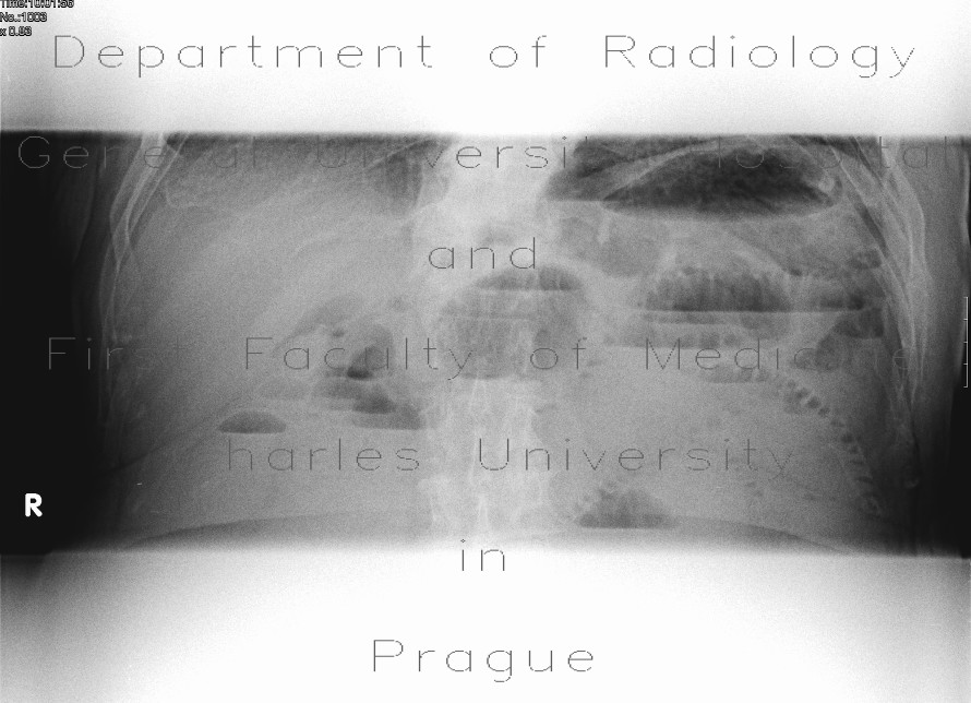 Ileus, tumor of hepatic flexure