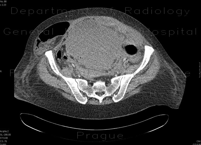 Radiology image - Incarcerated hernia, hematoma of abdominal wall: Abdomen, Large bowel, Peritoneal cavity, Small bowel, Soft tissue: CT - Computed tomography