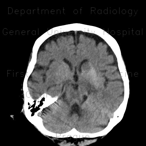 Infarction in basal ganglia, hemorrhagic transformation