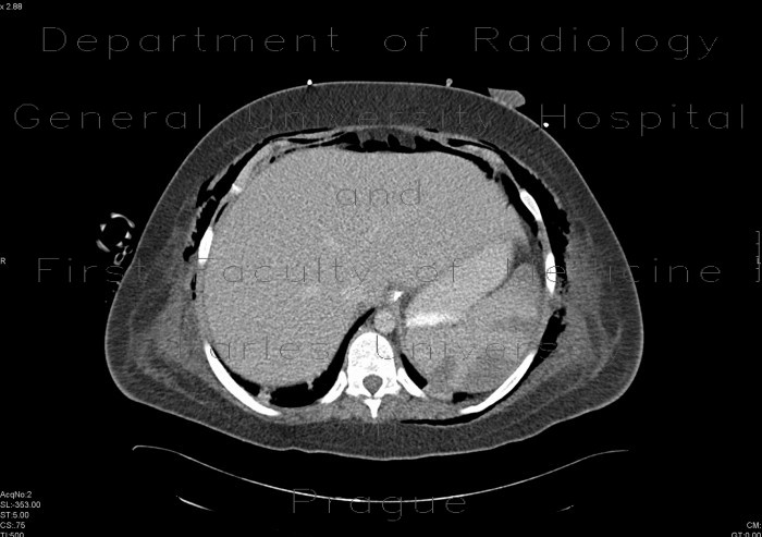 Radiology image - Infarctions of spleen: Abdomen, Lymphatic: CT - Computed tomography