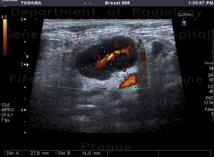 Inflammatory lymph node