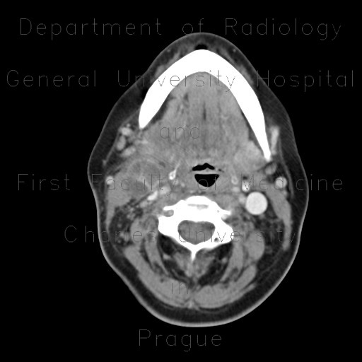 Inflammatory lymph node with liquefaction