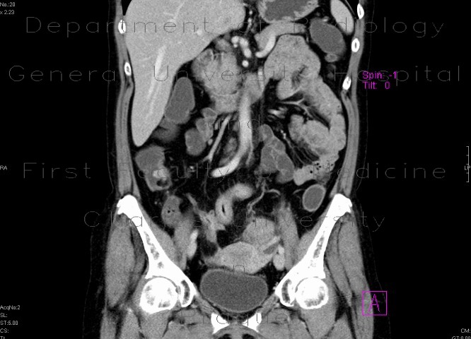 Radiology image - Inflammatory polyp adjacent to ileocecal valve in Crohn