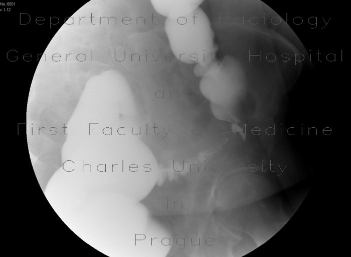 Inflammatory stenosis of sigmoid colon, diverticulitis