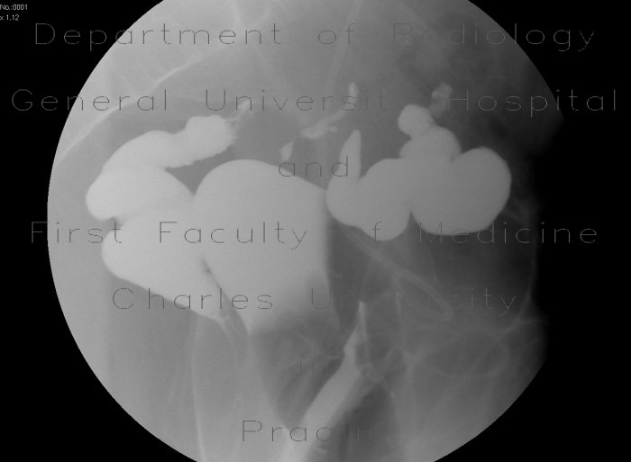 Radiology image - Inflammatory stenosis of sigmoid colon, sigmoid fistula, irrigography: Abdomen, Gynecology, Large bowel: RF - Fluoroscopy