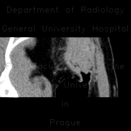 Radiology image - Inflammatory tumour of descending colon, CT colonography: Abdomen, Large bowel: CT - Computed tomography