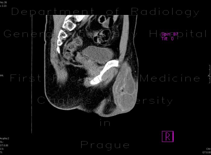 Radiology image - Inguinal hernia, laparoscopic repair, remained peritoneal sac with hematoma: Abdomen, Peritoneal cavity, Urinary tract: CT - Computed tomography