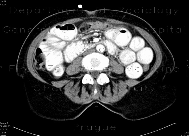 Radiology image - Inguinal hernia, small bowel ileus: Abdomen, Peritoneal cavity, Small bowel: CT - Computed tomography