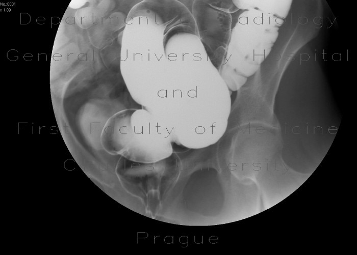 Inner hemorrhoids, irrigography