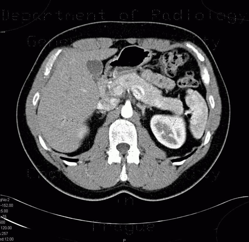 Insulinoma, before operation