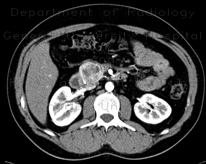 Radiology image - Insulinoma of pancreas: Abdomen, Pancreas: CT - Computed tomography