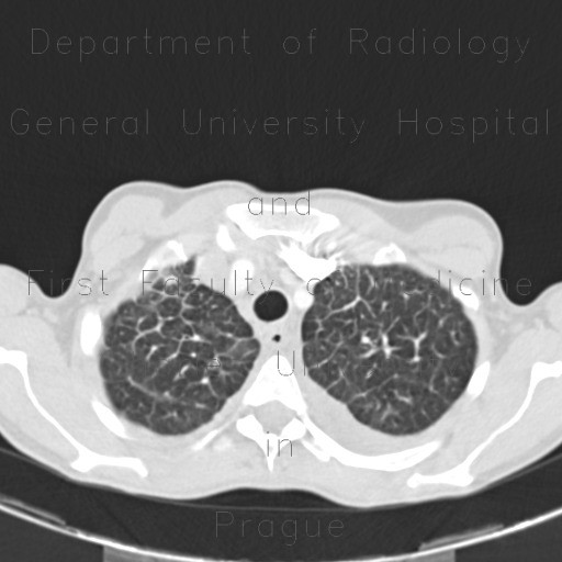Interstitial edema of the lung