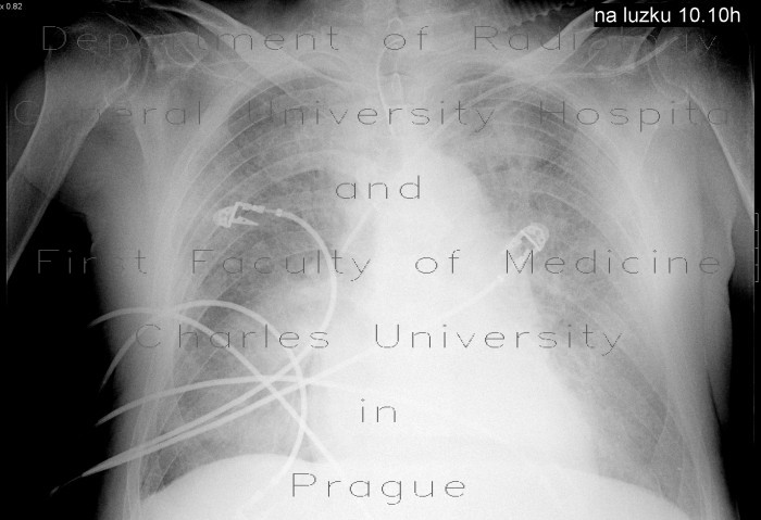 Interstitial lung edema