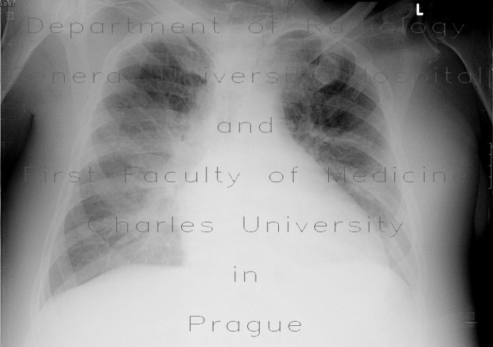 Interstitial lung edema