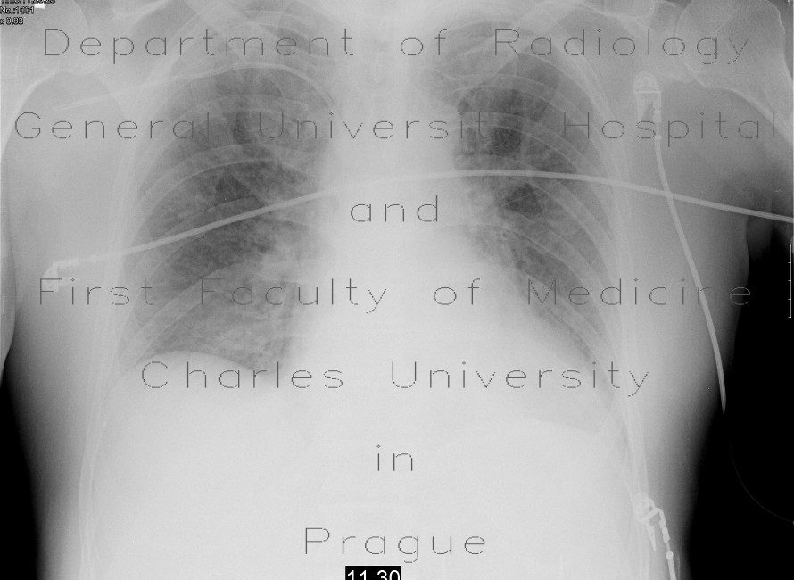 Interstitial lung edema