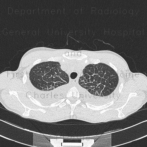 Radiology image - Interstitial lung edema, smooth thickening of interlobular septa: Thorax, Lung: CT - Computed tomography