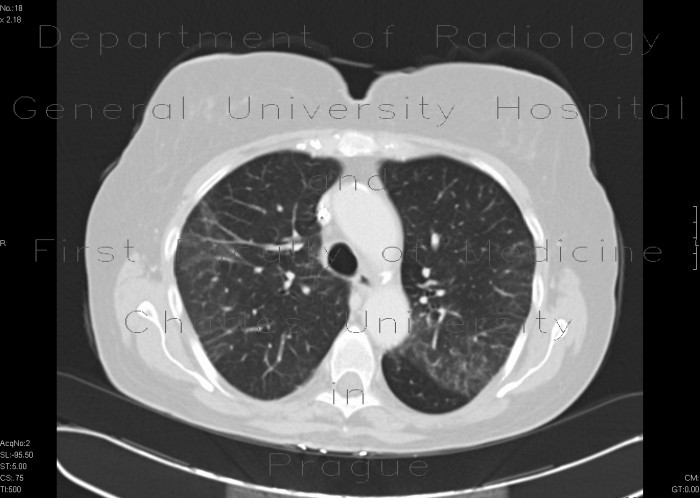 Radiology image - Interstitial pneumonia, HRCT: Thorax, Lung: CT - Computed tomography