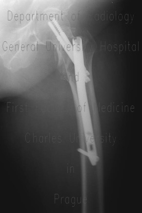 Intertrochanteric hip fracture, osteosynthesis, dynamic screws