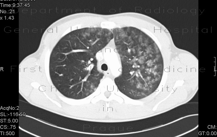 Radiology image - Intraalveolar hemorrhage, case 1: Thorax, Lung: CT - Computed tomography